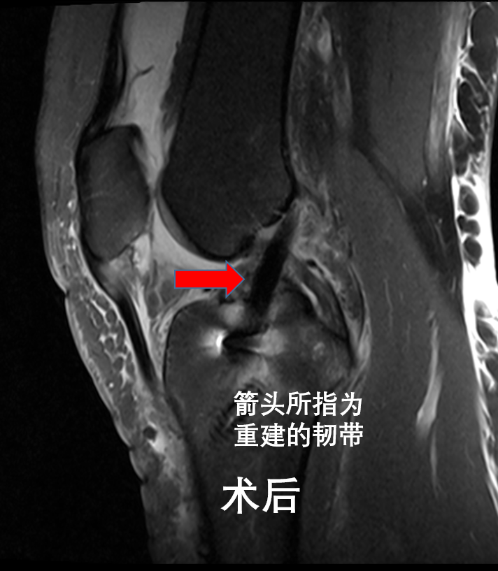 关于季后赛带伤作战！杰威接受右手韧带撕裂修复手术的信息